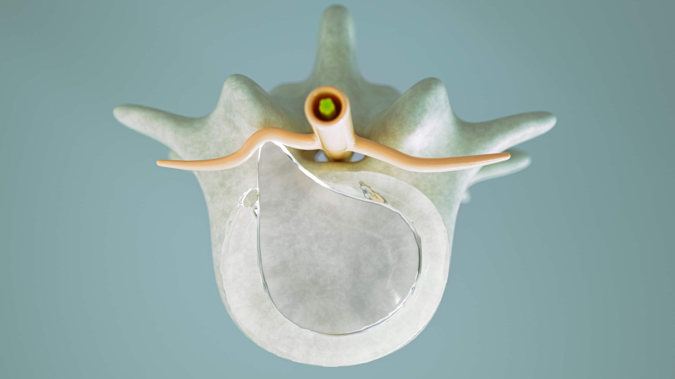 foto de protusão discal