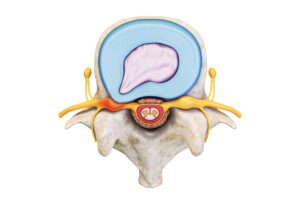 foto de protusão discal