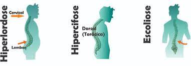 Hiperlordose e Hipercifose são desvios de coluna