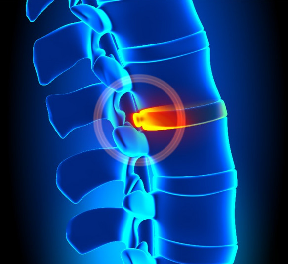 abaulamento discal