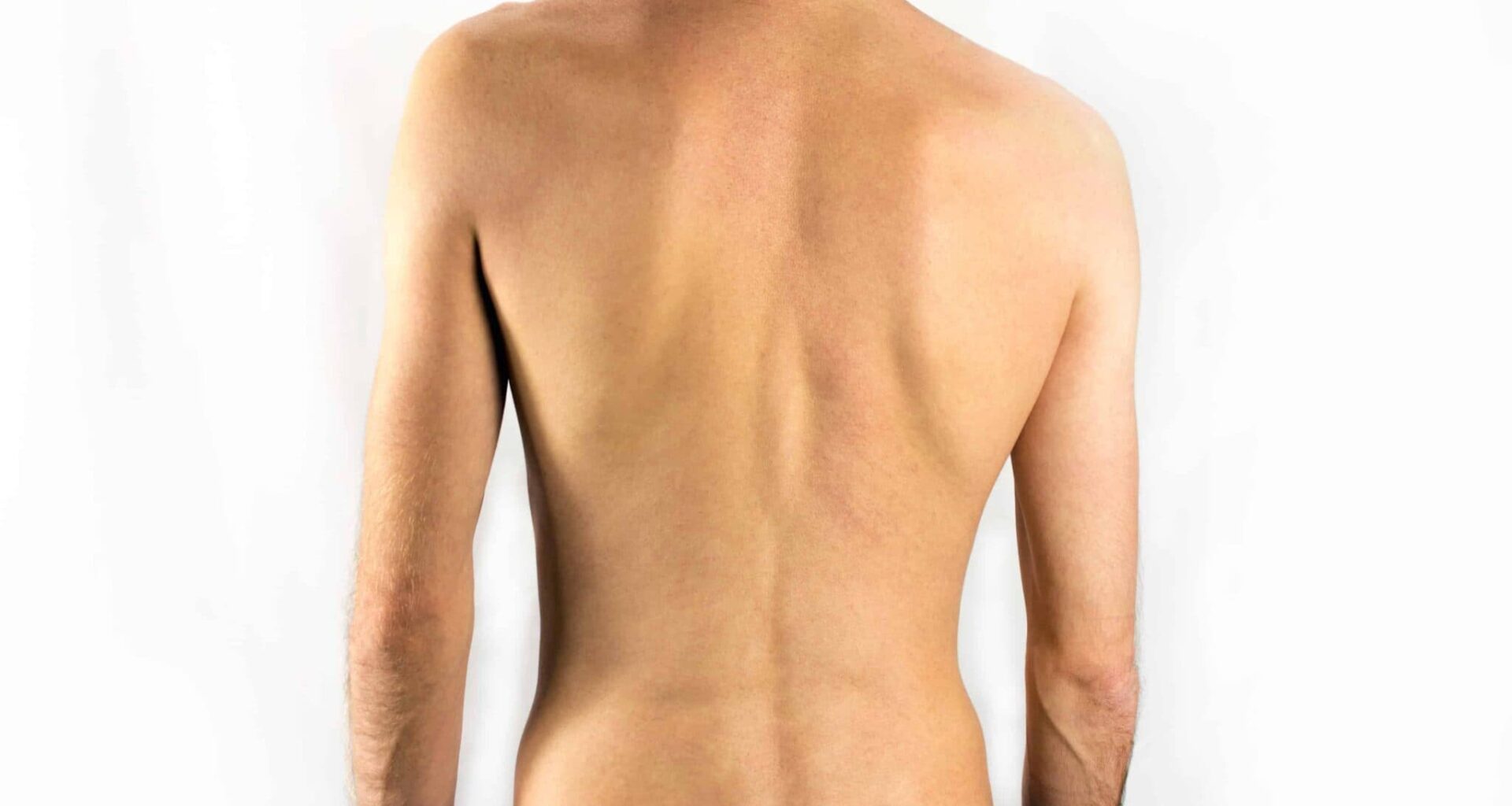 foto de pessoa com escoliose