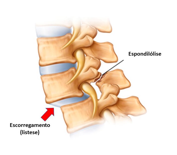 Espondilolistese: Causas e Como Tratar - ITC Vertebral