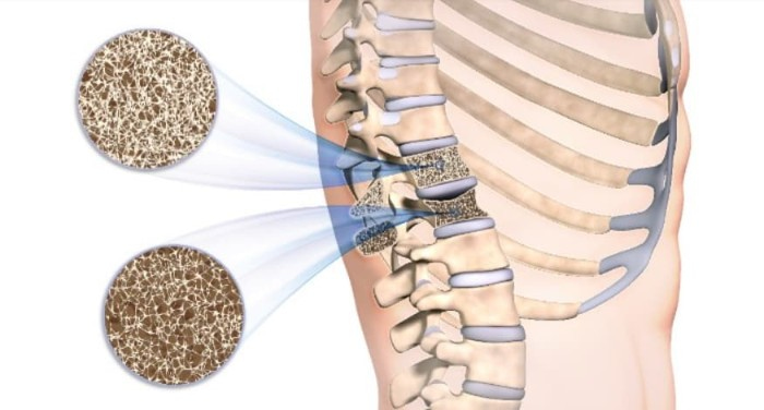 foto de osteopenia