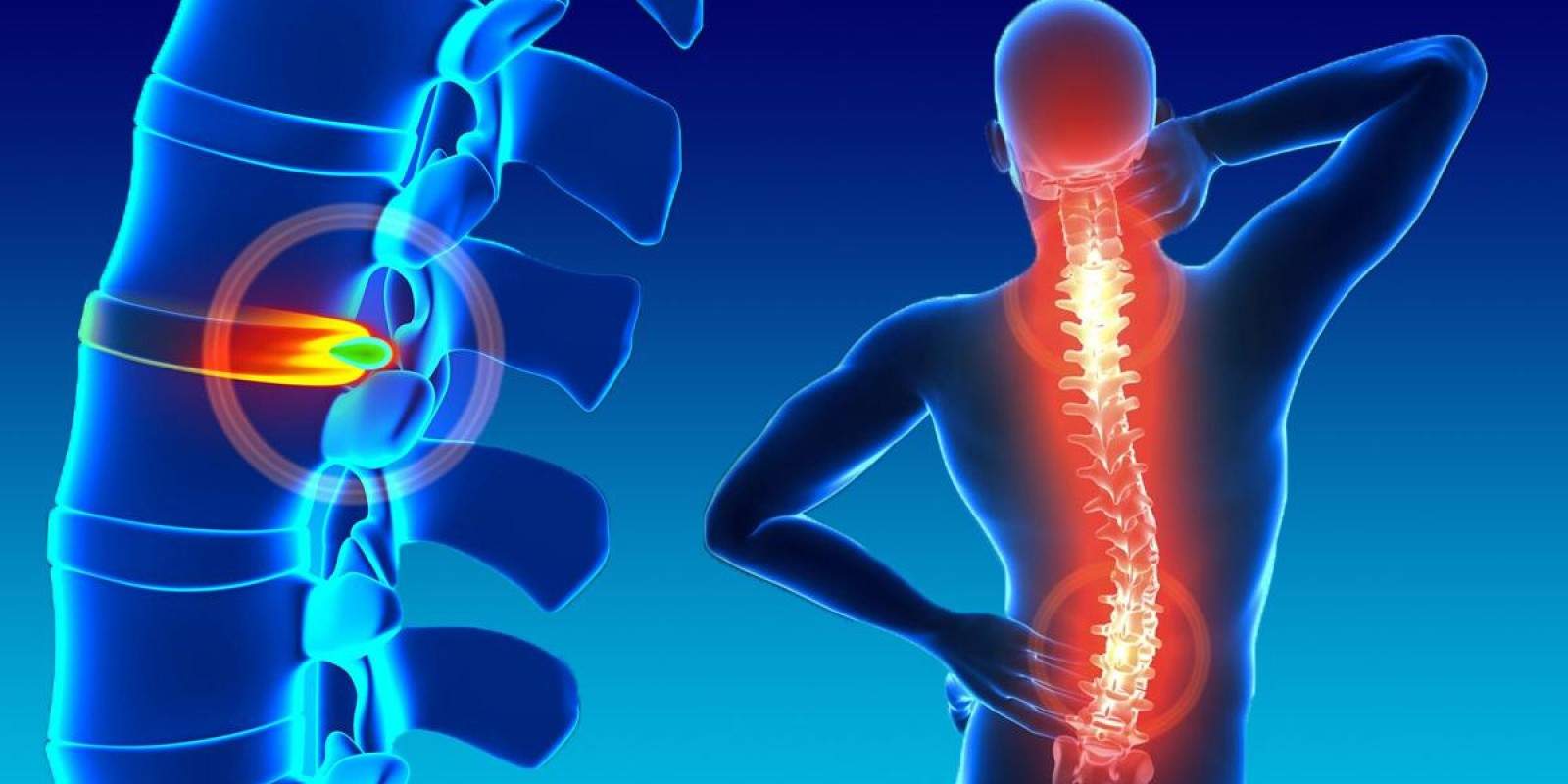 Quem Tem Hernia De Disco Lombar Pode Fazer Caminhada Tempo de afastamento por hérnia de disco - ITC Vertebral