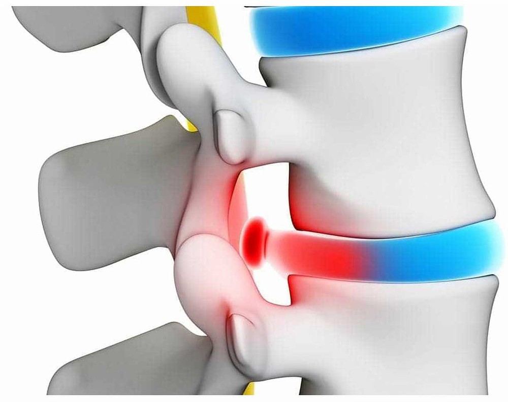 A hérnia de disco é o rompimento do anel vetebral.