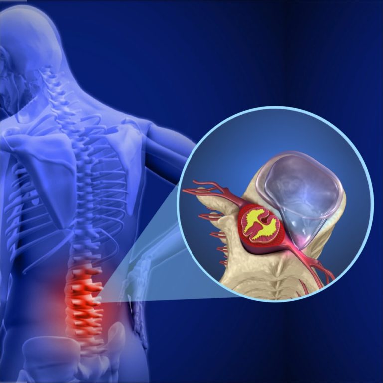 Quem Tem Hernia De Disco Lombar Pode Fazer Caminhada Quem Tem Hérnia De Disco Pode Andar De Bicicleta? - ITC Vertebral