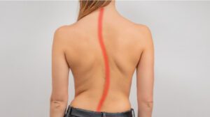 foto de exercícios para escoliose