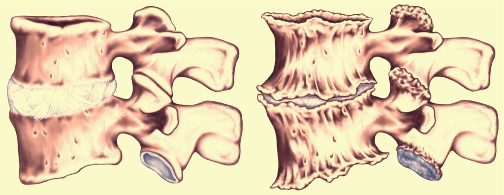 esquema mostrando vertebras com Retrolistese