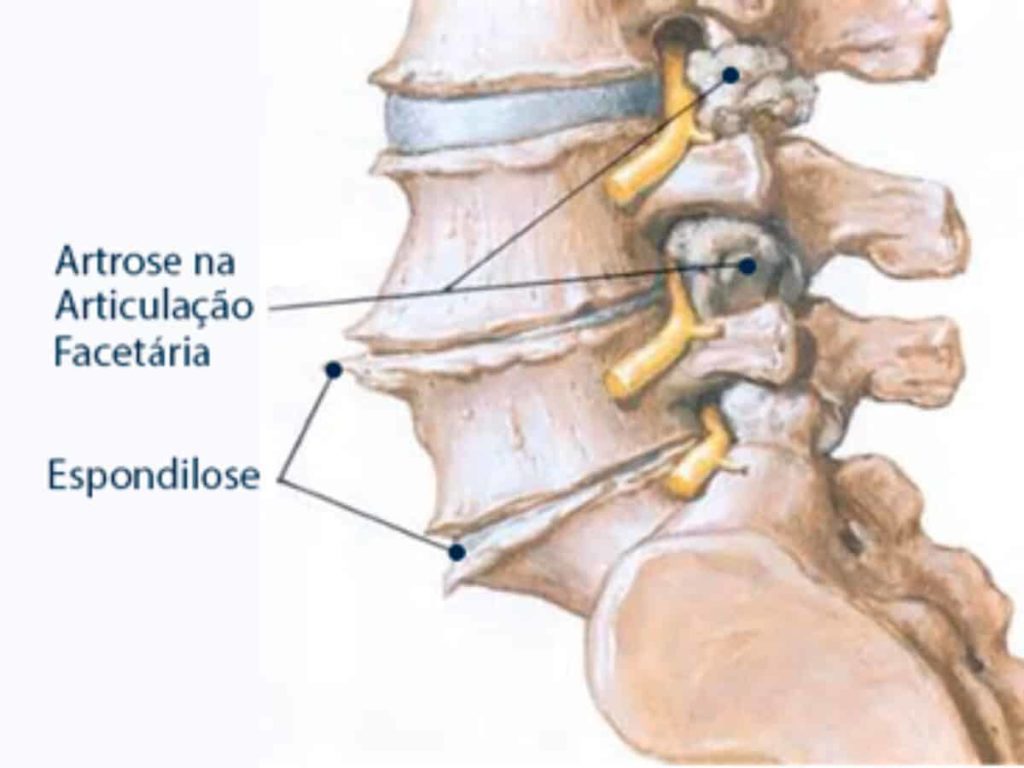 desenho da coluna vertebral mostrando a espondilose cervical