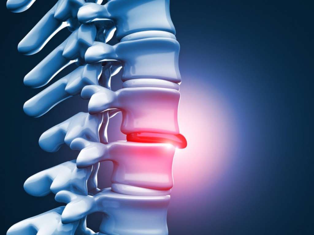 esquema mostrando coluna vertebral com Nódulo de Schmorl