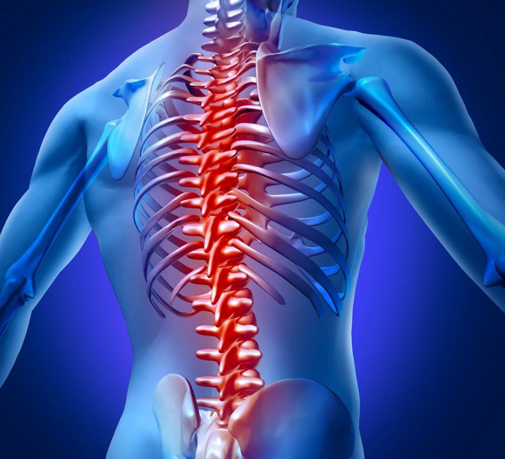 esquema mostranso desenho da coluna vertebral com retrolistese