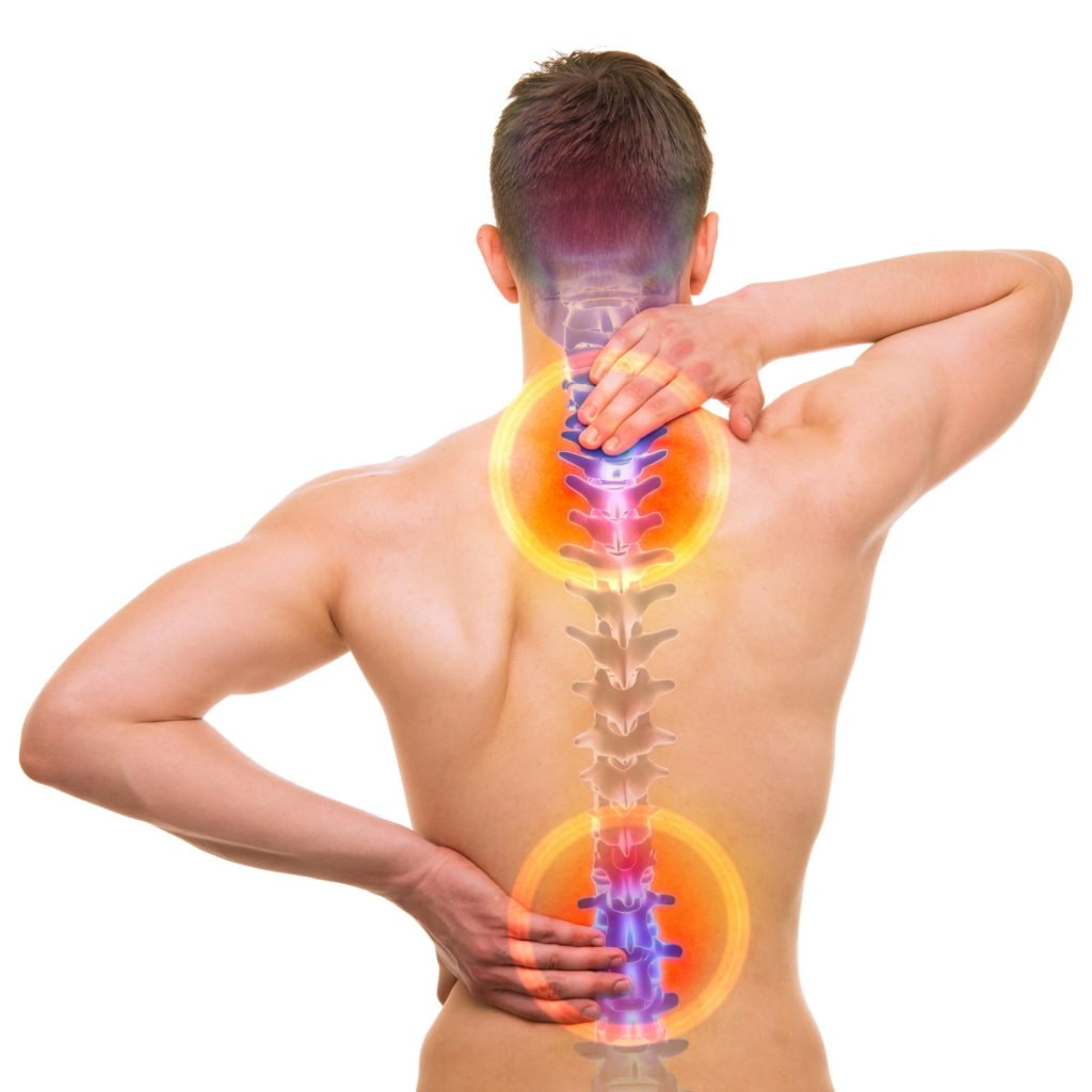 foto de radiculopatia
