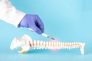 foto de Cifoplastia