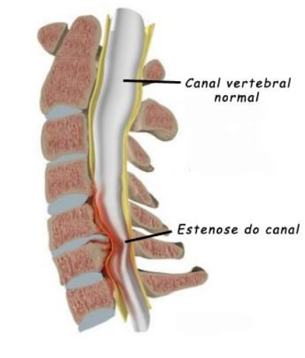claudicação neurogênica
