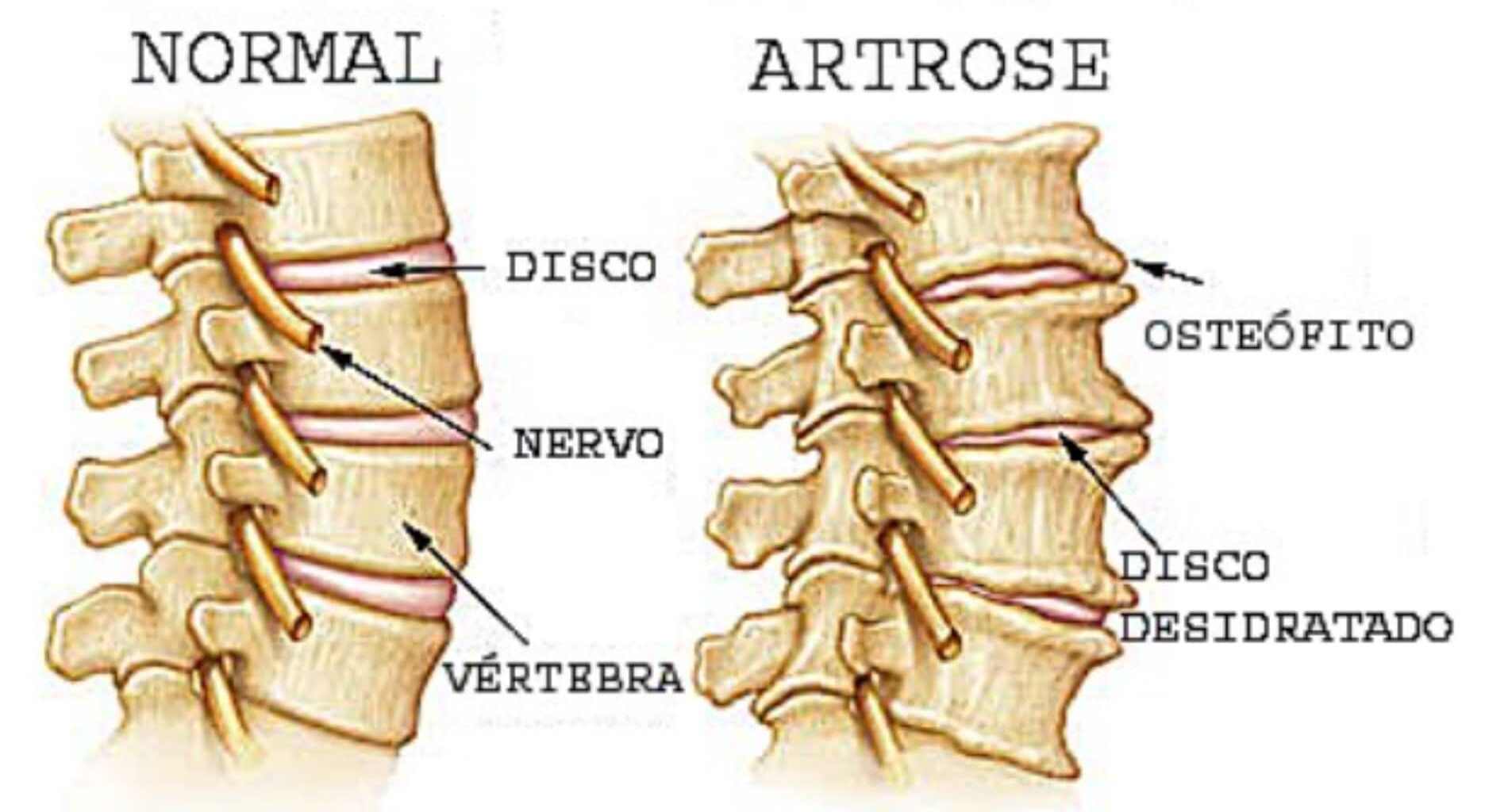 Espondilose torácica tem cura? - ITC Vertebral