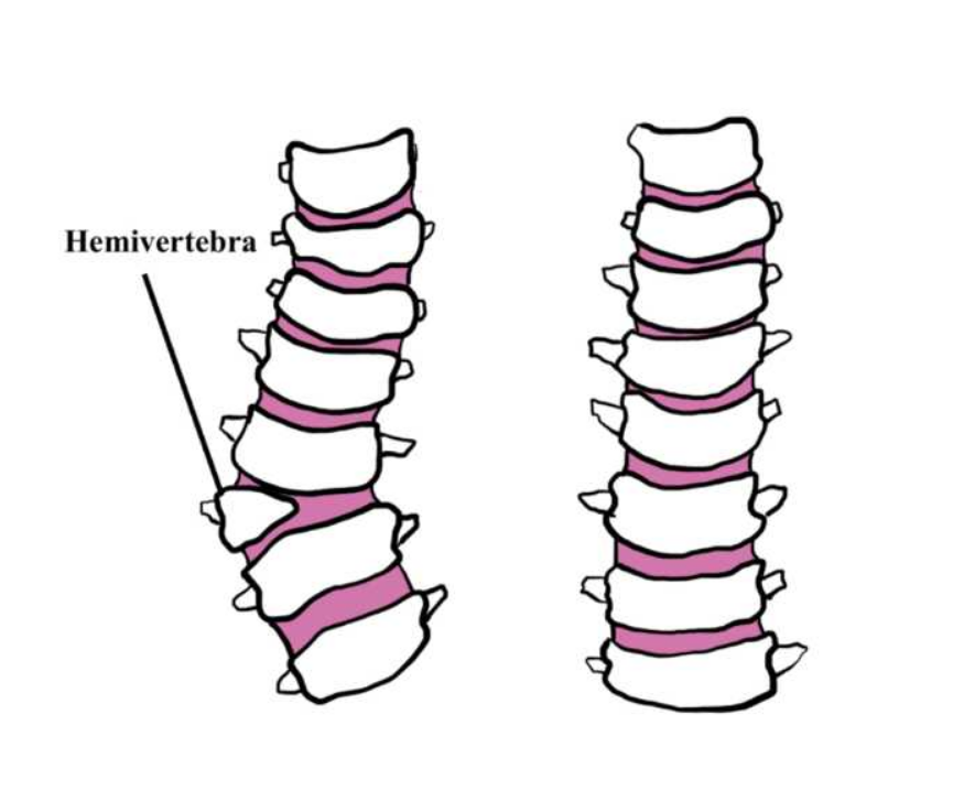 foto de hemivertebra