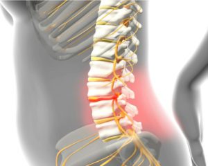 Como saber se tenho hérnia de disco: A hérnia de disco pode pressionar as raízes nervosas próximas ou outros tecidos moles na coluna vertebral