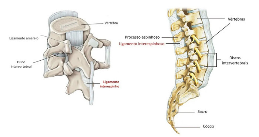 esquema do edema dos ligamentos interespinhosos