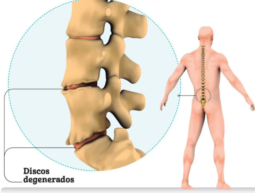 A espondilodiscopatia degenerativa, também conhecida como doença degenerativa discal ou DDD, é um tipo de distúrbio crônico musculoesquelético que afeta a coluna vertebral.