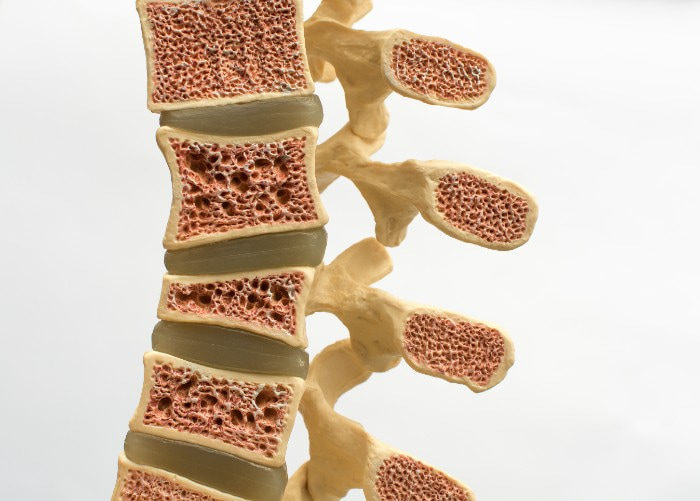 foto de osteoporose na coluna