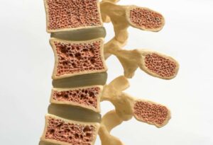 foto de osteoporose na coluna