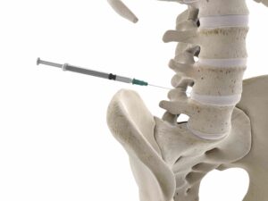 A infiltração foraminal (também conhecida como bloqueio foraminal ou da raiz lombar) é um procedimento minimamente invasivo usado para injetar medicamentos no forame da coluna vertebral.