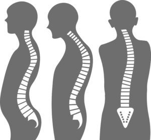 fotos de curvaturas da coluna vertebral