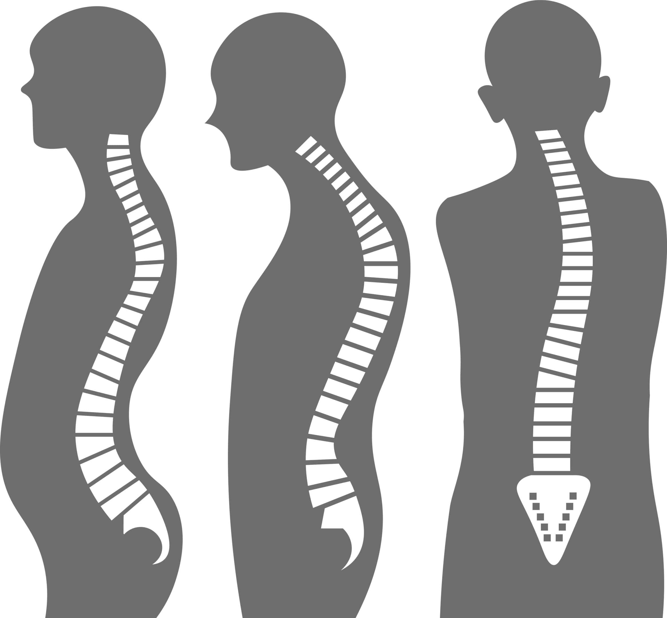 fotos de curvaturas da coluna vertebral