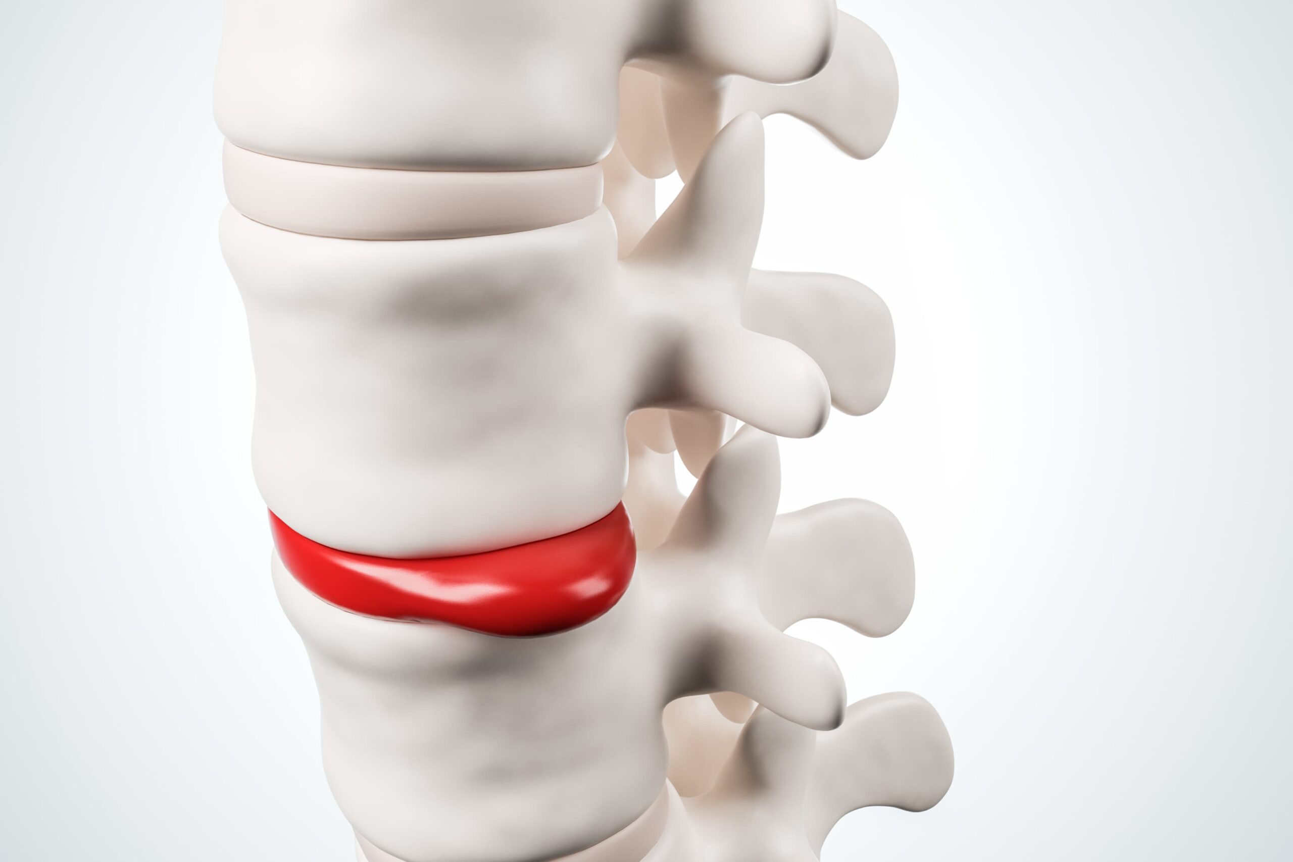 Cirurgia na coluna é perigoso? - ITC Vertebral