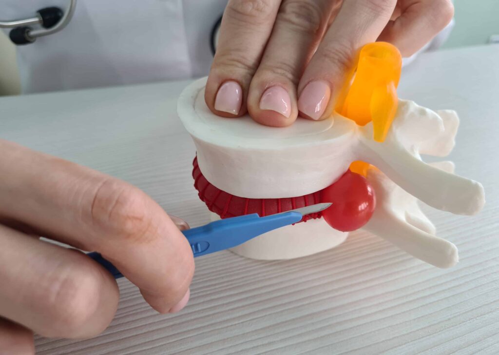 Modelo da coluna vertebral com uma hérnia de disco extrusa, sendo apontada por um bisturi cirúrgico. A imagem contrasta o tratamento cirúrgico para hérnia de disco com a abordagem não invasiva e conservadora promovida pela clínica.