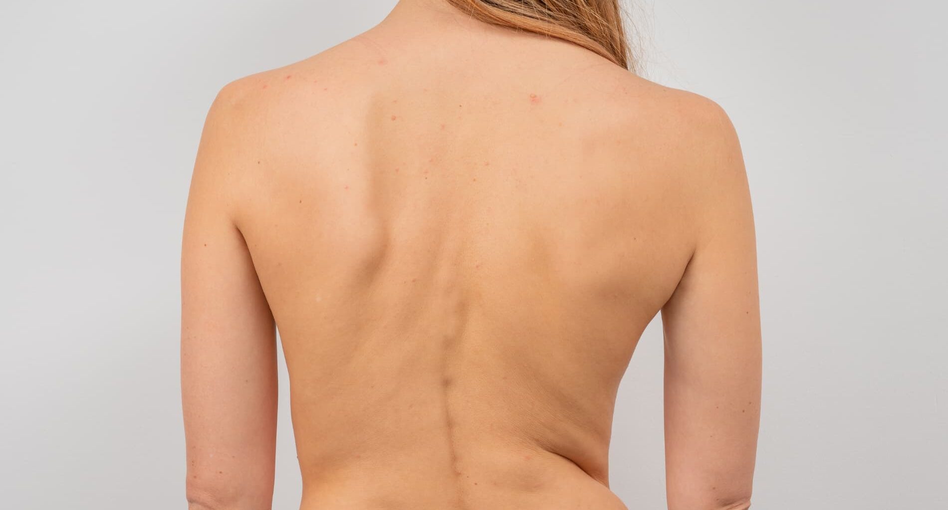 foto de fisioterapia para escoliose