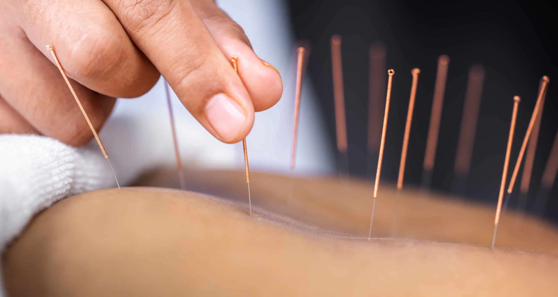 Acupuntura: para que serve? - ITC Vertebral