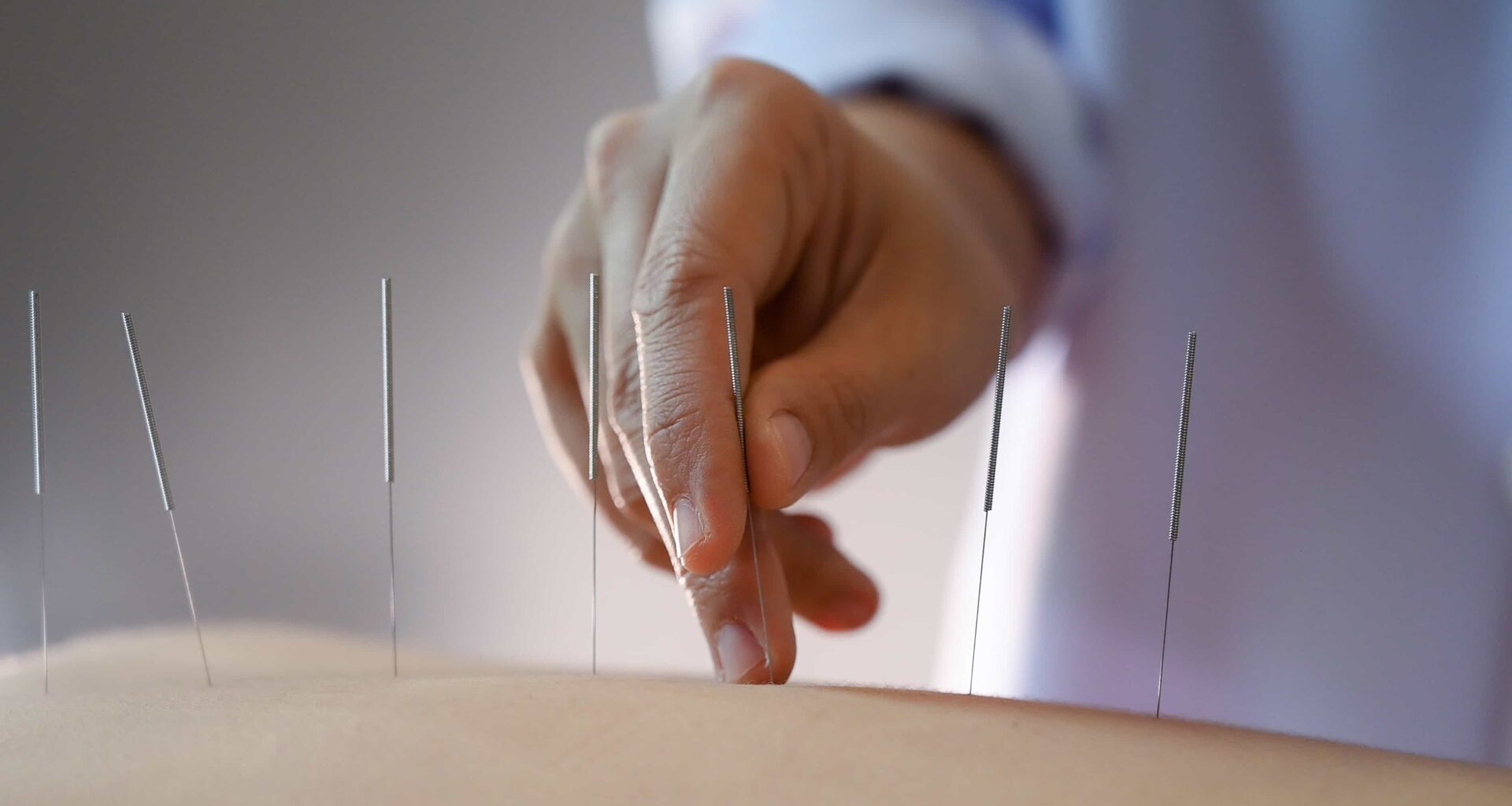 acupuntura-para-que-serve-itc-vertebral
