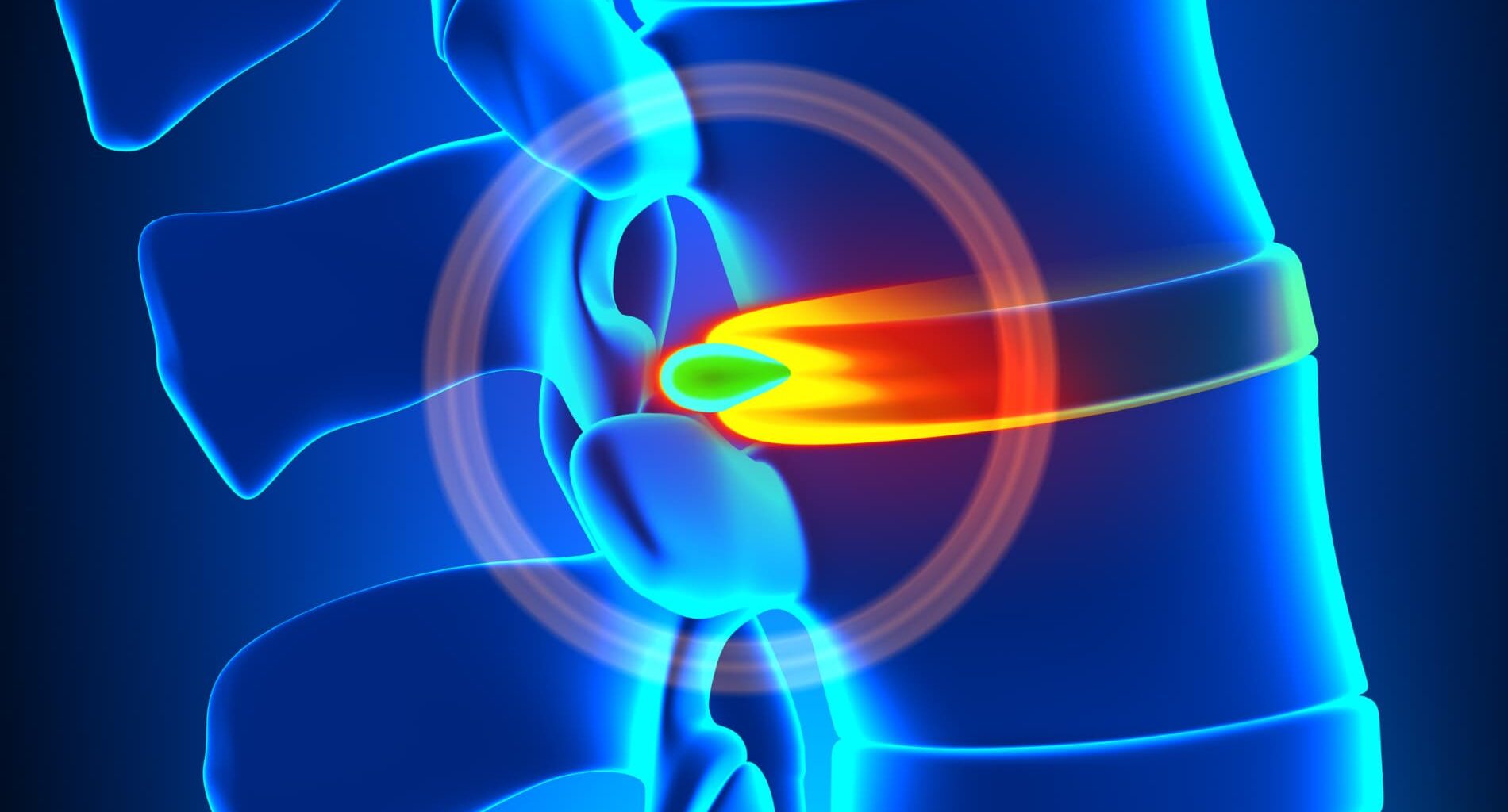 foto de hernia de disco remedio