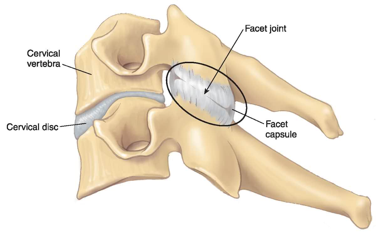 artrose vertebral tratamentos