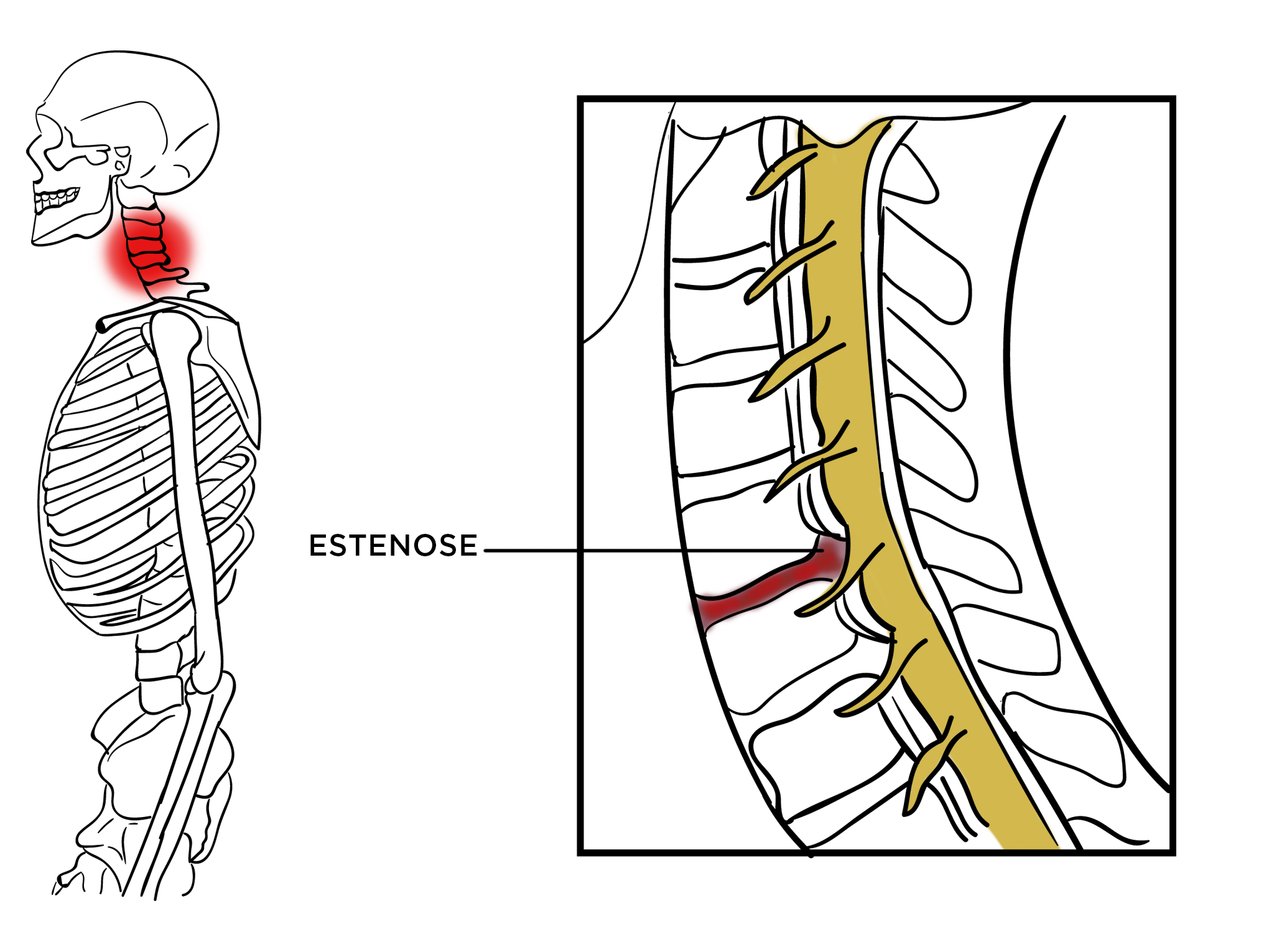 ilustração estenose cervical