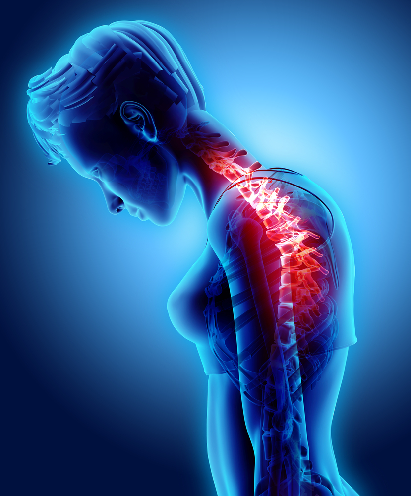 Esquema mostrando coluna cervical com mielopatia