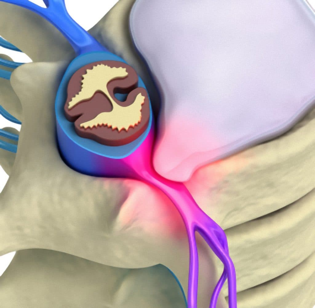 A protusão discal é uma distensão ou saliência do anel fibroso que envolve os discos intervertebrais.