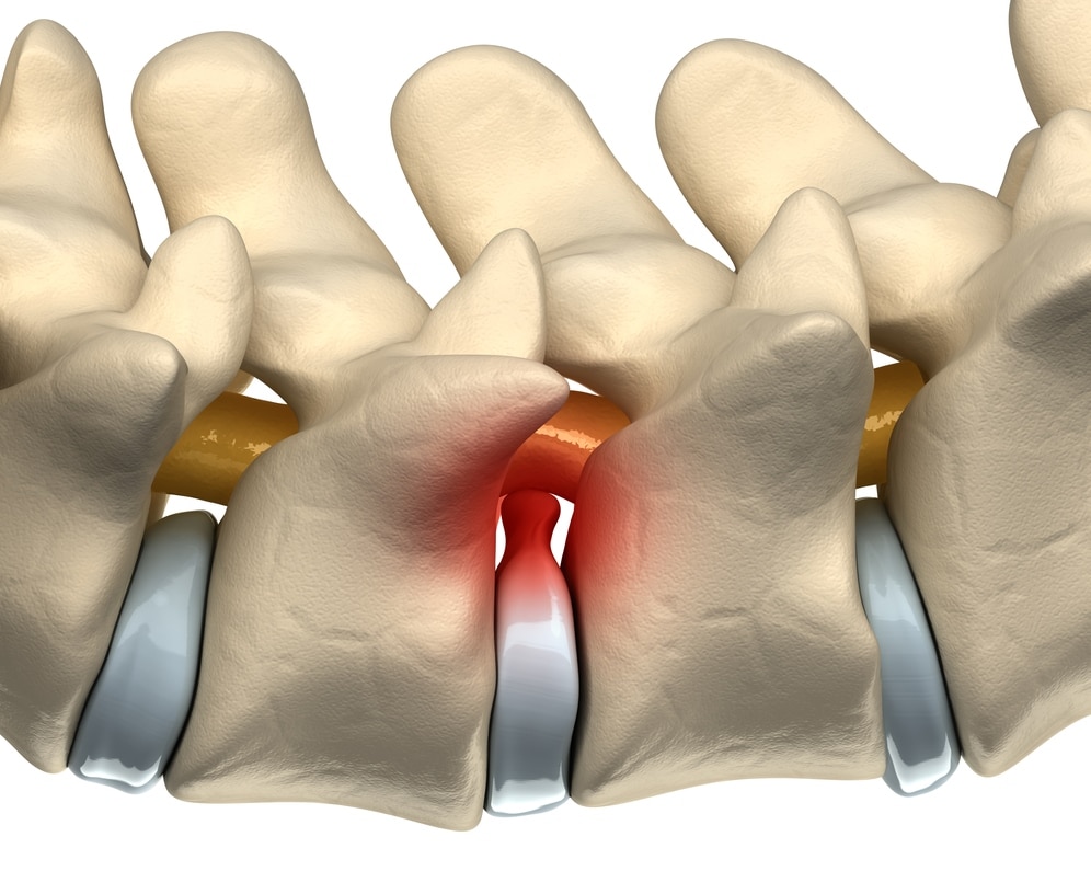 Alguns casos de protusão discal exigem tratamento cirúrgico.
