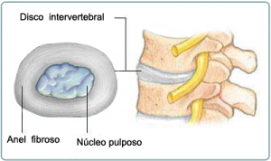 hérnia-de-disco-disco-intervertebral