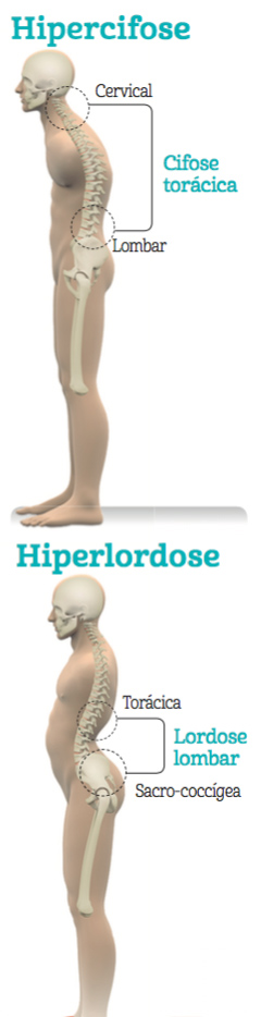 hiperlordose-hipercifose
