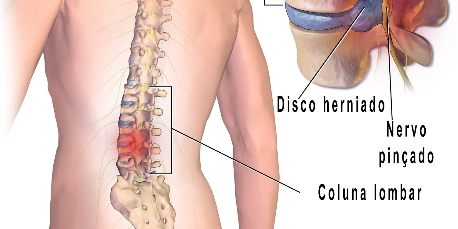 A hérnia de disco lombar é uma inflamação dos discos da coluna.