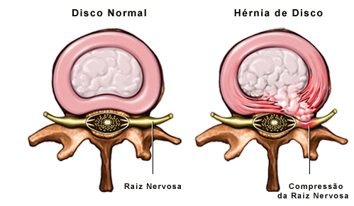 Hérnia de disco? O que é, Causas, Sintomas e Tratamentos - ITC Vertebral